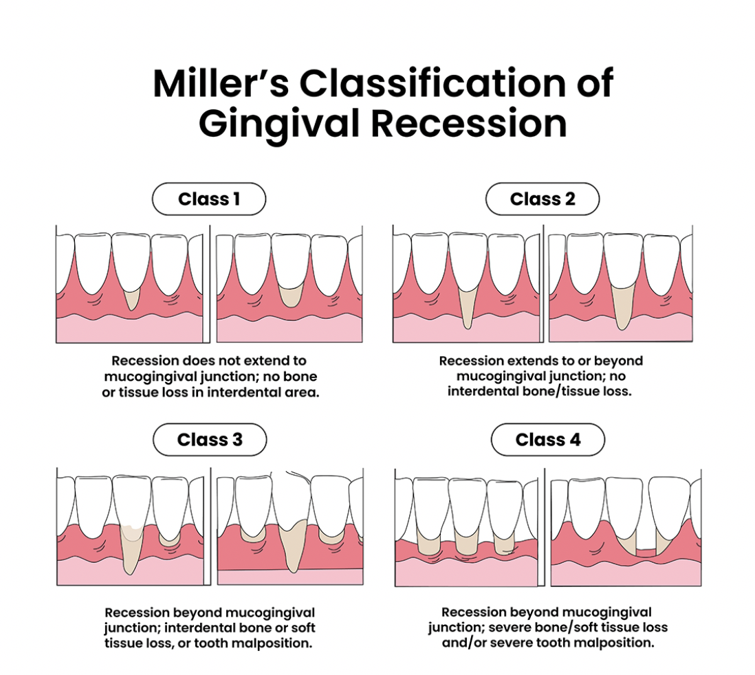 Miller's classification